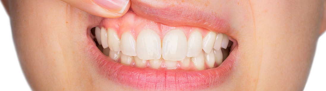 Musterbild für Rezessionsdeckung der Zahnarztpraxis 32 schönezähne in Forchheim