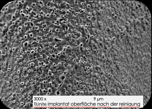 Periimplantitis Implantat Oberfläche nach der Reinigung, Behandlungsbild der Zahnarztpraxis 32 schönezähne in Forchheim